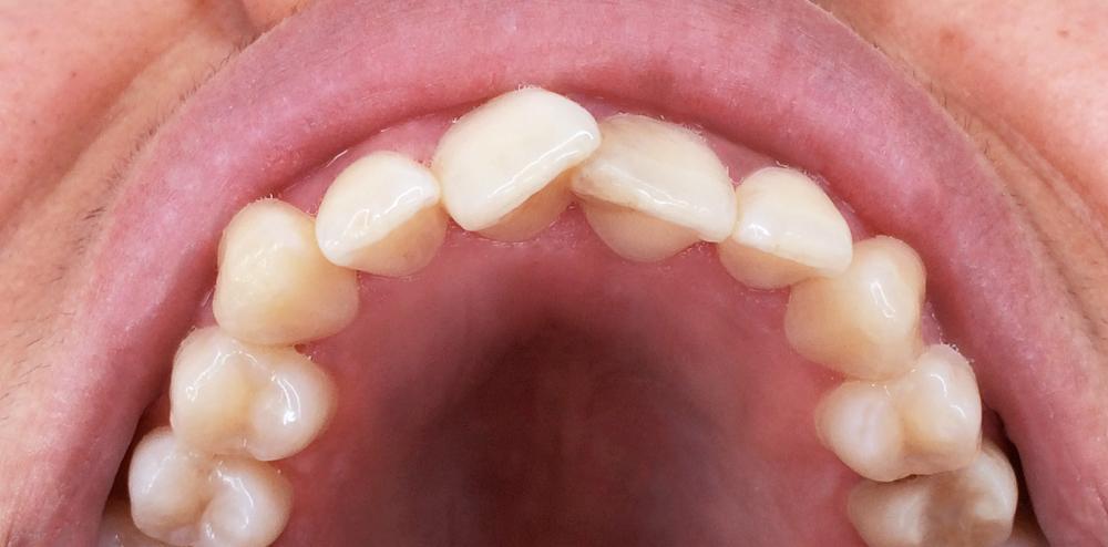 Aligner before and after