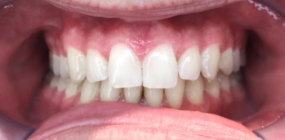 Aligner After