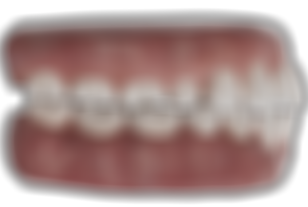 Clear Aligners I bestsmile