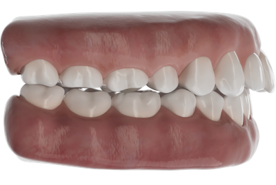 Overbite treatment with aligners