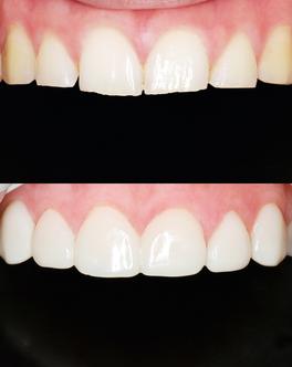 Denti scheggiati prima e dopo