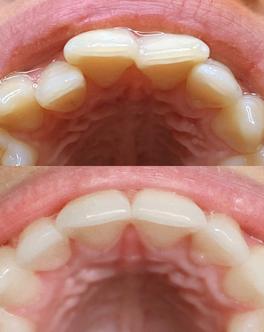 Crooked teeth – before and after