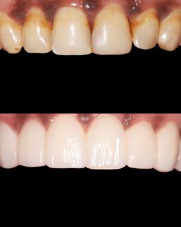 Discoloured teeth – before and after