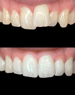 Encombrement dentaire avant-après