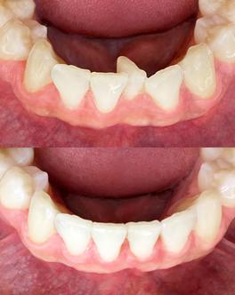 Encombrement dentaire avant-après