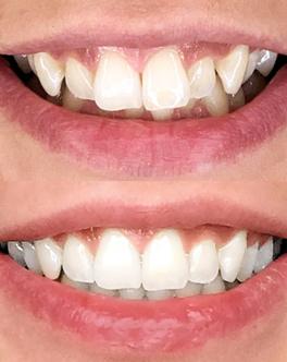 Crooked teeth – before and after