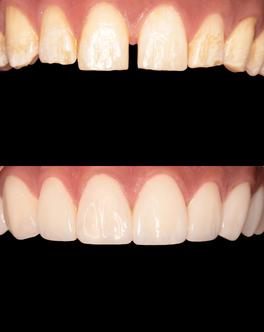 Discoloured teeth – before and after