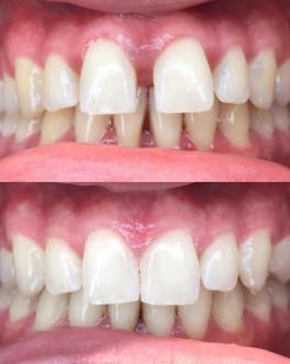 Diastème: avant / après