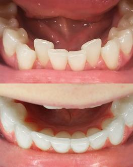 Encombrement dentaire avant-après