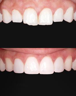  Dents cassées avant-après