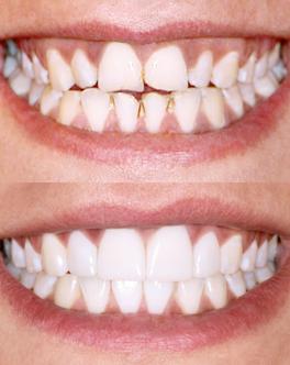 Discoloured teeth – before and after