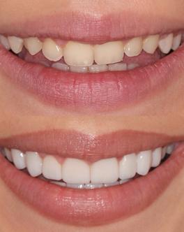 Uneven teeth – before and after