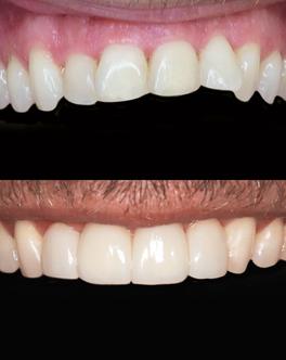Uneven teeth – before and after