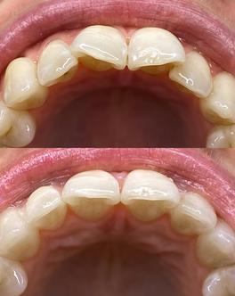 Dents tordues: avant/après