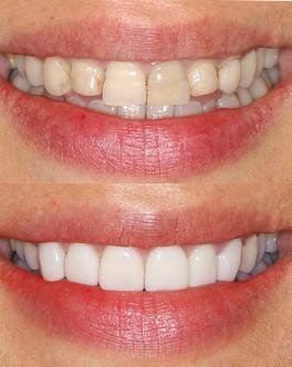 Denti scoloriti prima e dopo