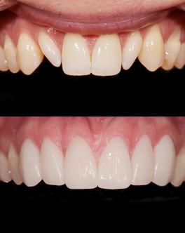 Prima e dopo: anomalie dentali e difetti ai denti anteriori