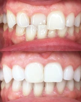 Crossbite before after