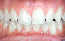 Teeth whitening before after