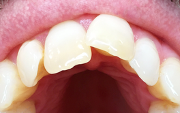 Schöne Zähne mit Aligner