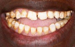 Veneers before after