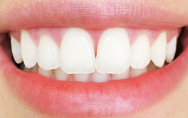 Aligners before after