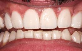 Veneers Behandlung Nachher