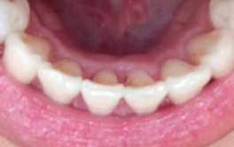 Schöne Zähne mit Aligner