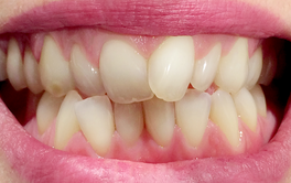 Aligners before after