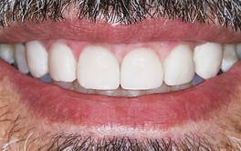 Veneers Behandlung Nachher
