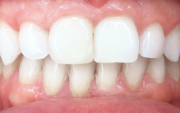 Aligners treatment after