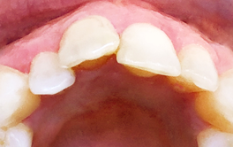 Schöne Zähne mit Aligner