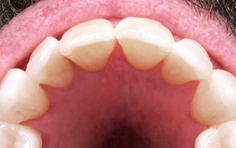 Faccette dentali dopo