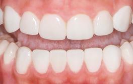 Veneers treatment after