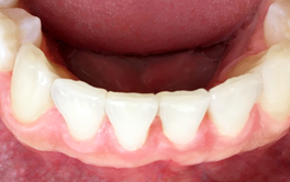 Schöne Zähne mit Aligner