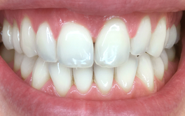 Aligners before after