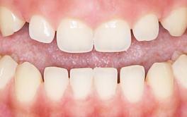 Veneers before after