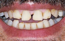 Veneers vorher Nachher