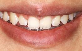 Veneers vorher Nachher