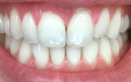 Bleaching vorher Nachher