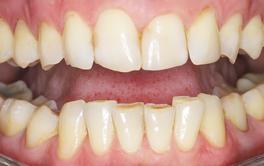 Veneers vorher Nachher