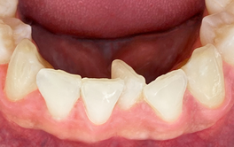 Schöne Zähne mit Aligner