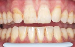 Veneers vorher Nachher