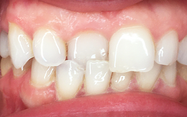 Schöne Zähne mit Aligner