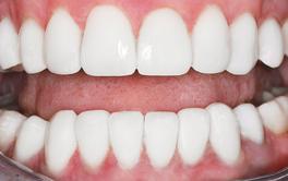 Veneers Behandlung Nachher