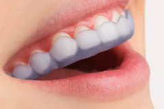 Gouttière de nuit anti-bruxisme