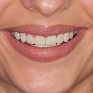 Denti naturali con faccette dentali