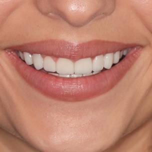 Denti bianchi con faccette dentli