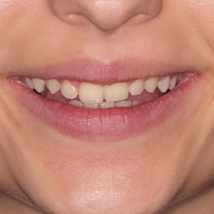 Denti naturali senza faccette dentali