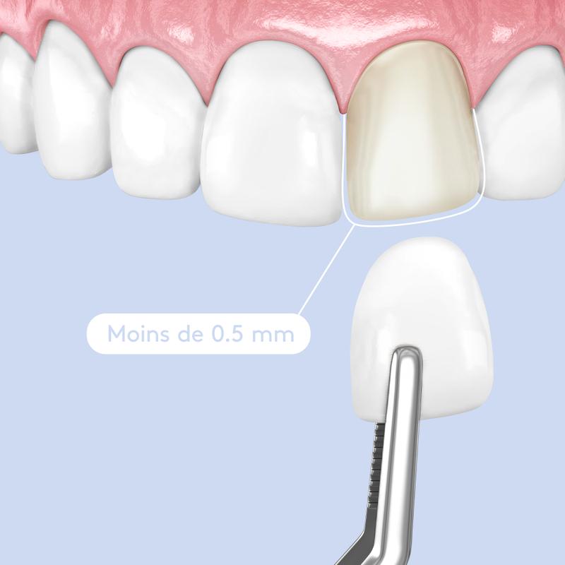 Retrait email facettes dentaires