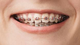 Apparecchio fisso con brackets